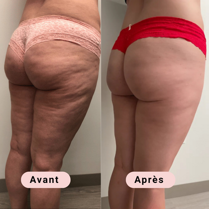 Zenvies™ Masseur Anti-Cellulite 2.0 Pro
